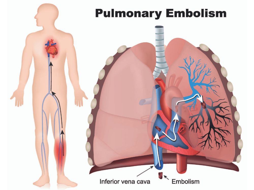 Pulmonary Embolism diagram