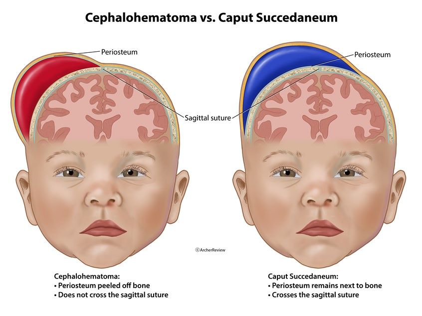 Caput Succedaneum and Cephalohematoma