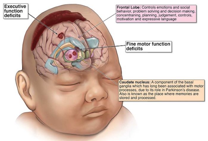 Hypoxic-Ischemic Encephalopathy