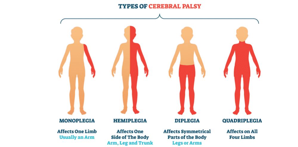 Illustration showing the stages of Spastic Cerebral Palsy in children
