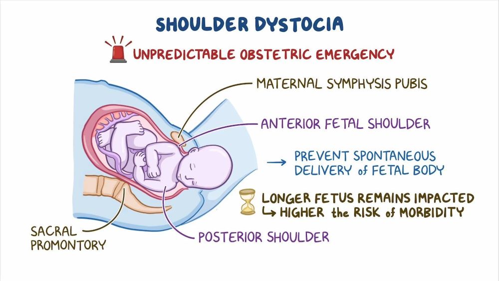 Detailed medical illustration showing the process of shoulder dystocia